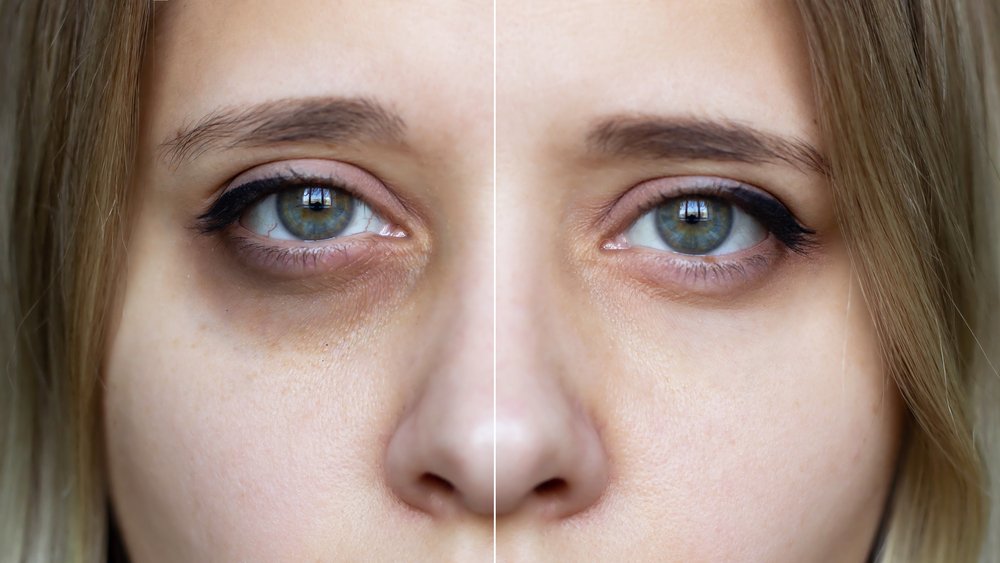 Phương pháp điều trị thâm quầng mắt tại VTM Oliver