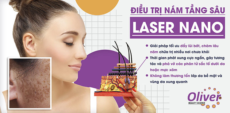 Công nghệ điều trị nám Laser Nano