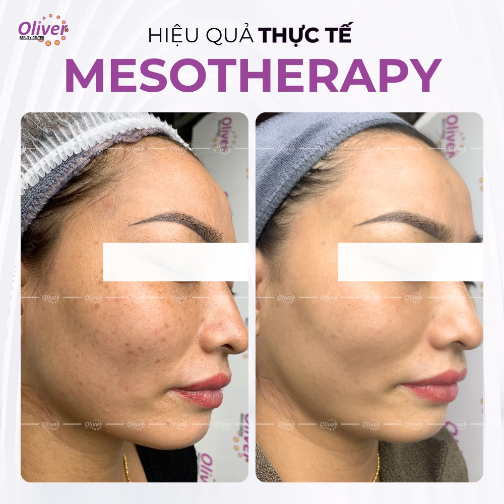 Mesotherapy – Giải Pháp Điều Trị Nám, Tàn Nhang Và Trẻ Hóa Da Tại Oliver